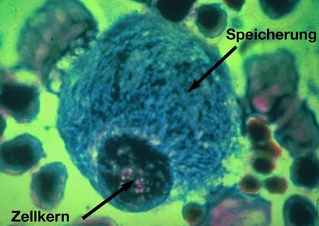 Mikroskopisches Bild der typischen Gaucher-Speicherzelle 
