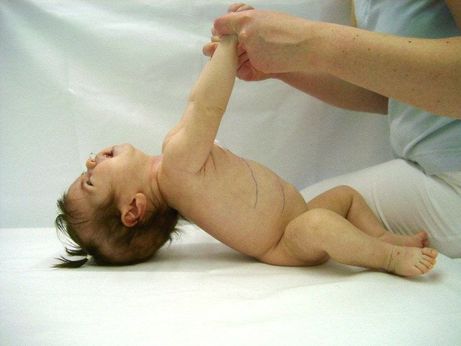 Säugling mit der „infantilen“ Form des Morbus Pompe