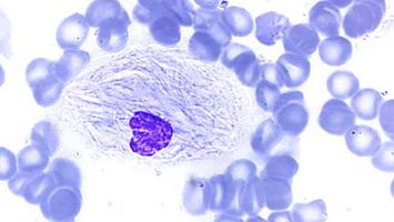 Gaucher-Speicherzelle, umgeben von vielen kleinen roten Blutkörperchen